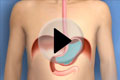 Reflux