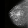 Mammográfia: Az emlő speciális röntgenvizsgálata