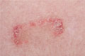 Psoriasis