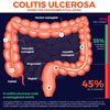 A fekélyes vastagbélgyulladásról (colitis ulcerosa)