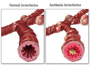 Az asthma patomechanizmusnak sms brzolsa; Forrs: www.nhlbi.nih.gov