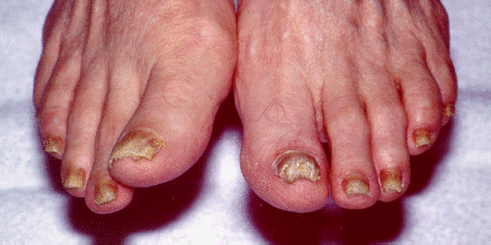 Onychomycosis, Körömgomba; Forrás: http://www.biotech-weblog.com