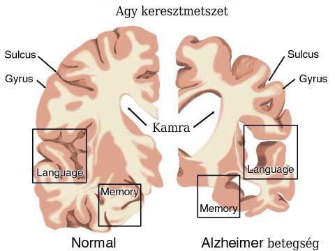 Az egészséges és Alzheimer betegségben szenvedő beteg agyának összehasonlítása