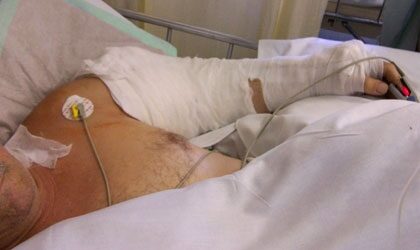 Sajóbábonyi munkahelyén szakadt le a karja a férfinak