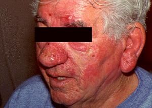 rosacea