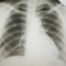Miért szükséges a tüdőszűrés?