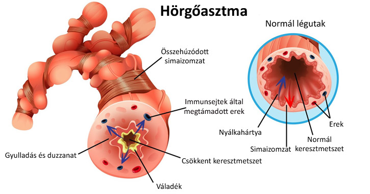 Asztma és normál légutak