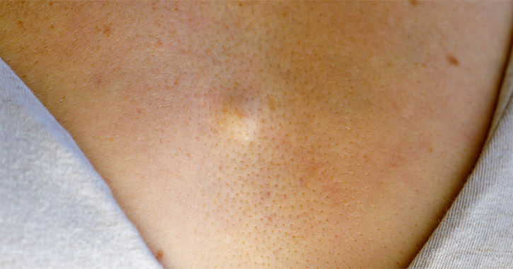 Atheroma