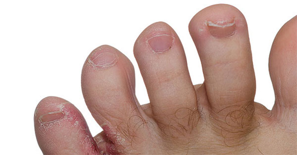 kezelése repedések ujjai között láb cukorbetegség)