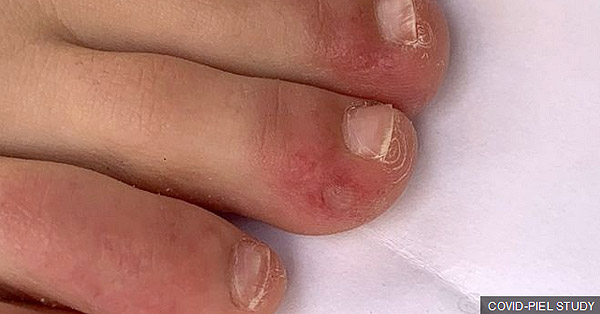 hogyan lehet ingyenes pikkelysömör gyógyszereket kapni vörös foltok az arcon fényképpel és leírással