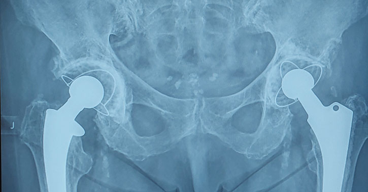 Csípőprotézis röntgen