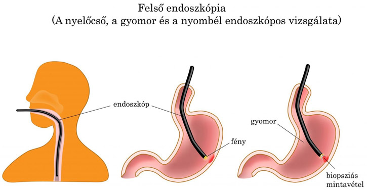 Gyomortükrözés