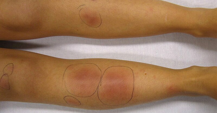 Erythema nodosum - lábszár