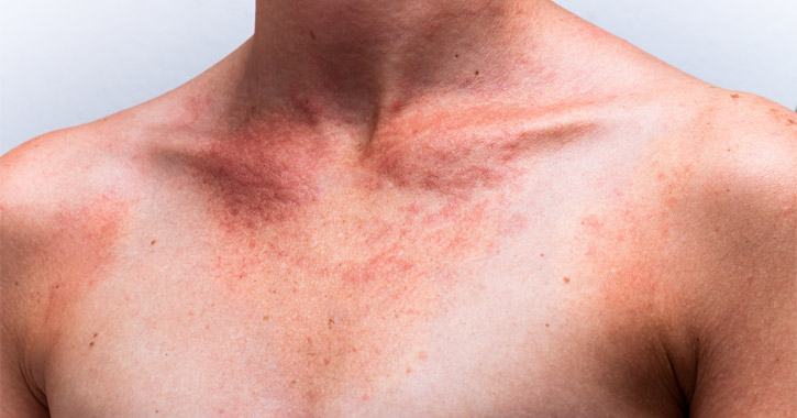 Fotodermatitisz: bőrreakció napsugárzás hatására