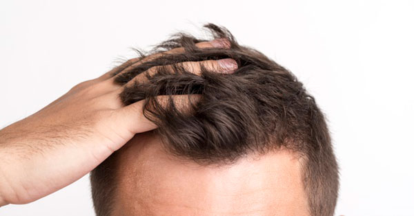 A foltos hajhullás okai és kezelése