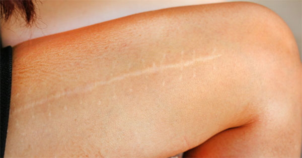 Dudor a homlokon a bőr alatt - mi ez és hogyan lehet eltávolítani a pecsétet - Diagnostics