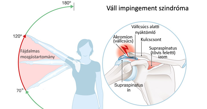 Vállfájdalom