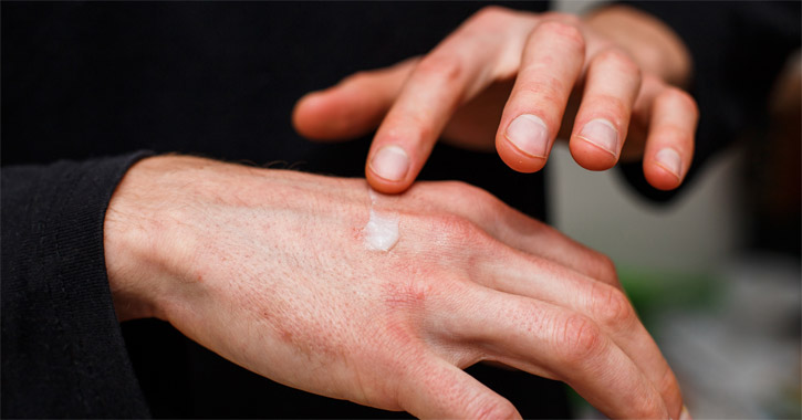 Kontakt dermatitisz