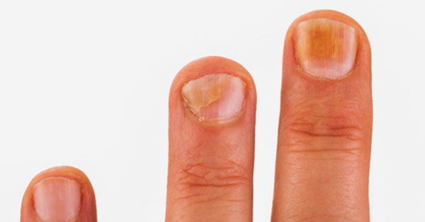 nail gombák tünetek fájdalom
