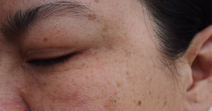 Melasma arcbőrön