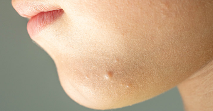 Uszodaszemölcs (molluscum contagiosum)