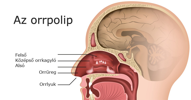 Orrpolip