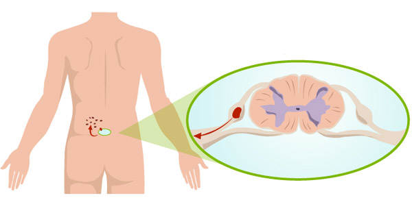 Övsömör (herpes zoster)