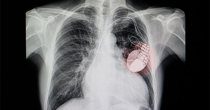 Beültetett pacemaker