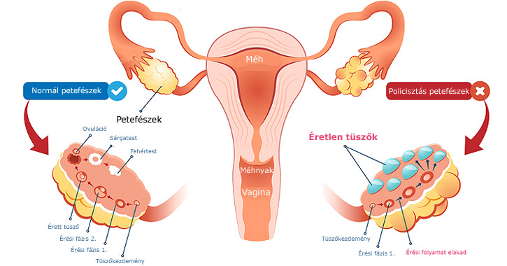 PCOS