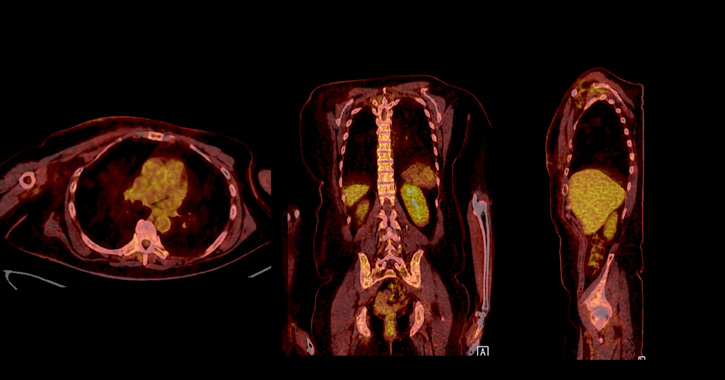 PET-CT-feltvétel