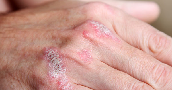 Pikkelysömör (pszoriázis, psoriasis) tünetei és kezelése