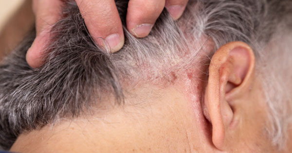 fül ekcéma tünetei vörös viszkető folt az alkaron