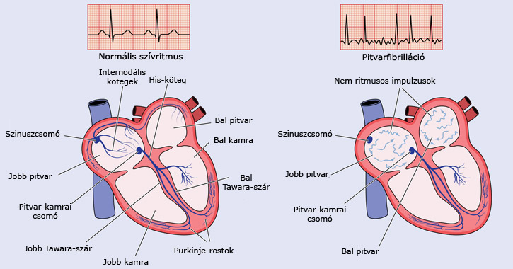 Pitvarfibrilláció ábra