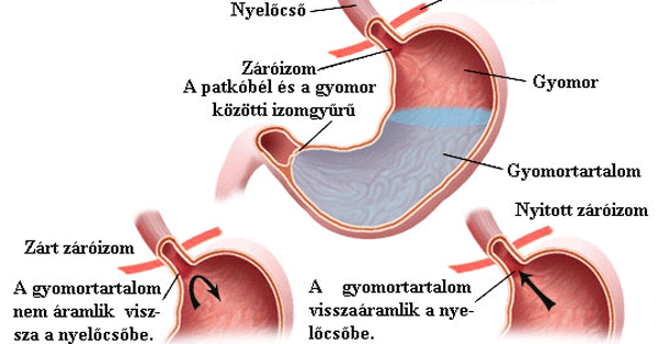 Reflux