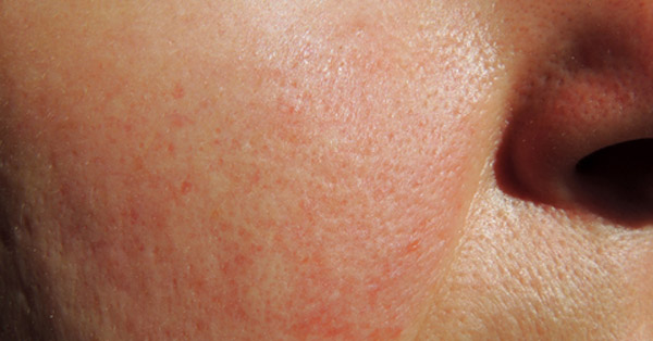 bőrproblémák kezelése bőrkiütés piros foltok formájában fotó