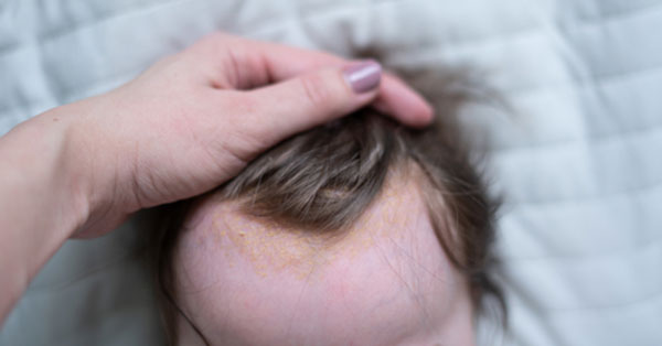 szeborreás dermatitis vagy szeborreás pikkelysömör kezelése vörös foltok a hason, a háton és a lábakon