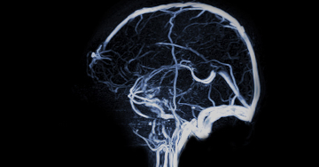 MR-angiográfia