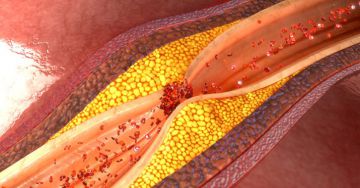 Aterotrombózis – Az érelmeszesedés egyik legsúlyosabb szövődménye