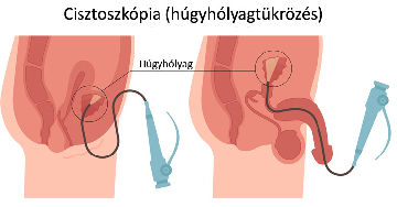 A húgyhólyagtükrözés (cisztoszkópia) menete