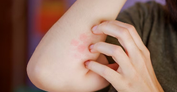 Mi csípett meg? A főbb rovarcsípések és jellemzőik