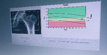 A csontritkulás nem csak az idősebb korosztályt fenyegeti