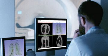 Tüdőrák diagnosztika: mesterséges intelligencia segít mellkas CT felvétel alapján
