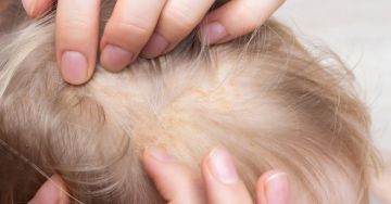 Zsíros, sárgás foltok utalhatnak seborrhoeas dermatitis-re