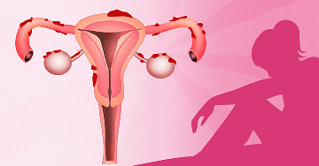 Tények és tévhitek az endometriózisról