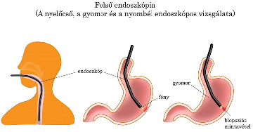 Gyomortükrözés - Mikor szükséges? Hogyan zajlik?