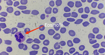 Eozinofil granulocita