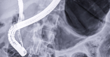 Diagnosztikai módszerek: ERCP