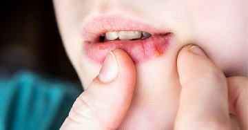 Ajakherpesz és nemi herpesz - Herpes simplex fertőzések