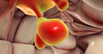 Prolaktinóma (hipofízis adenóma)