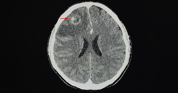 Kontrasztanyagos koponya-CT-vizsgálat